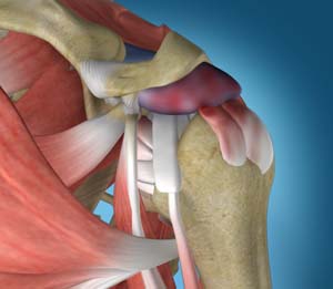 Subluxation