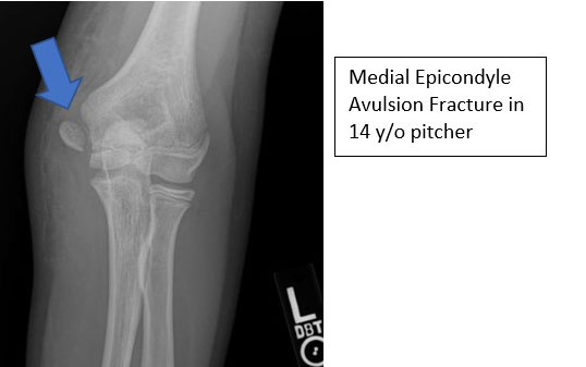 The Throwing Athlete