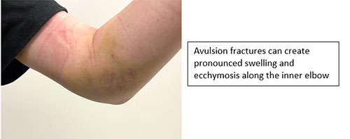 The Throwing Athlete