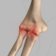Elbow Arthritis