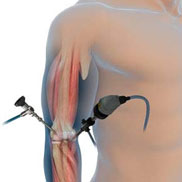 Elbow Arthroscopy