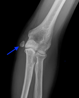 The Throwing Athlete