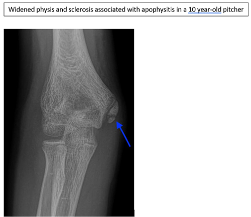 The Throwing Athlete