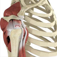 Rotator Cuff Tear