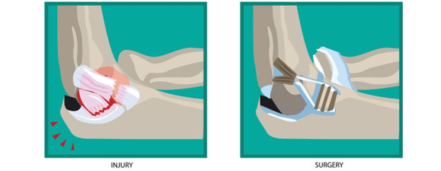 The Throwing Athlete