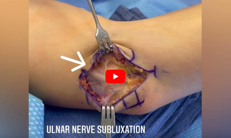 Snapping Triceps Syndrome