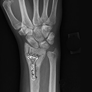 Wrist Open Reduction and Internal Fixation